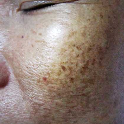 AGE SPOTS/ LIVER SPOTS