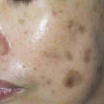 MELASMA/ CHLOASMA