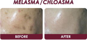 Melasma Chloasma