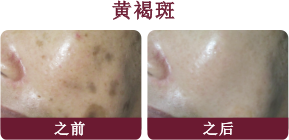 Melasma Chloasma